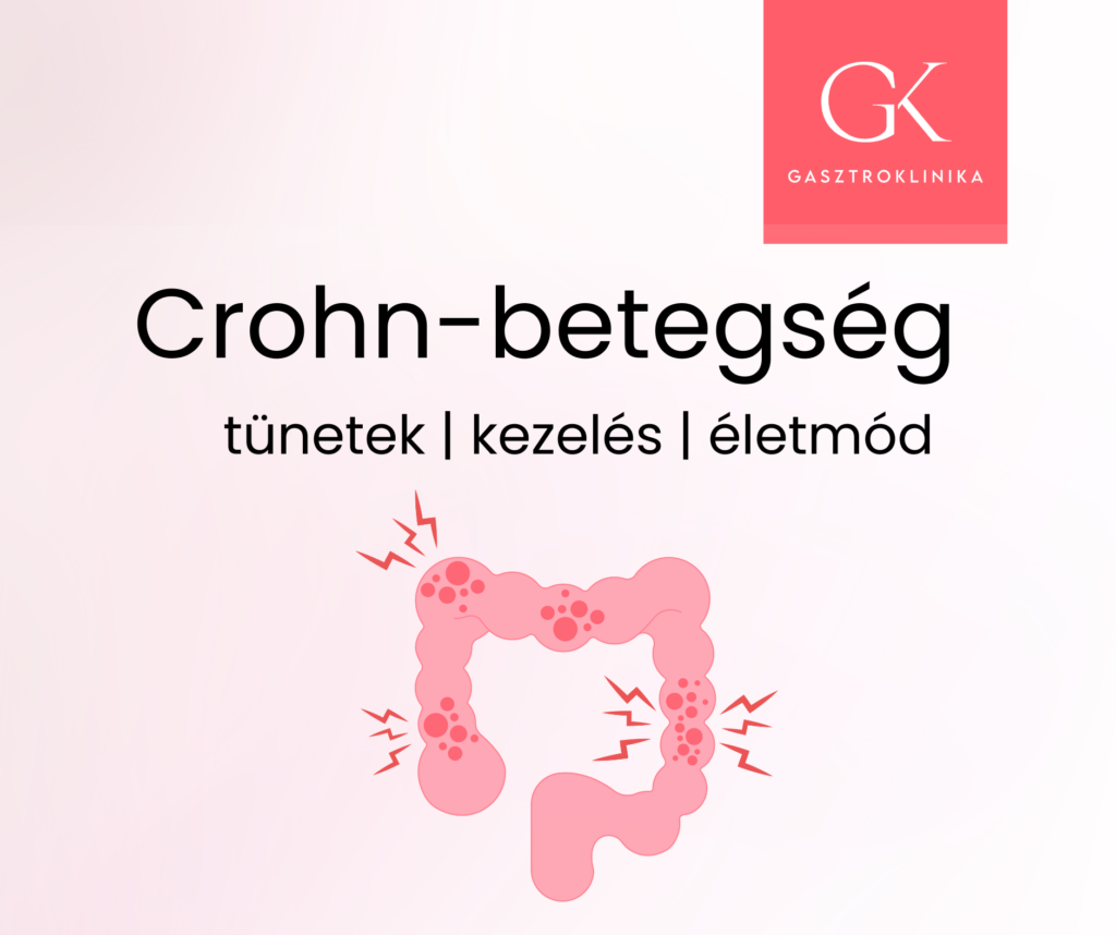 crohn betegség kezelése, tünetei és életmód