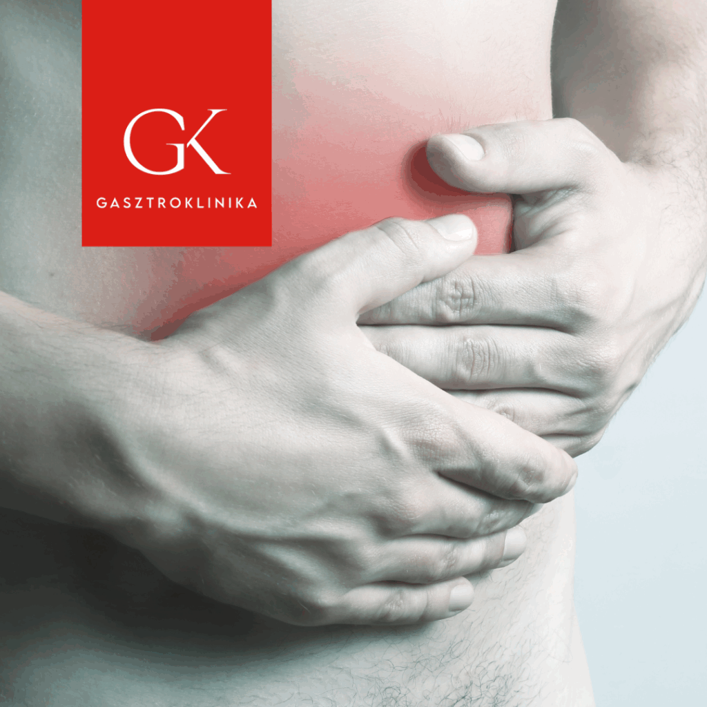 Diverticulosis és diverticulitis: tünetek, kezelés, étrend