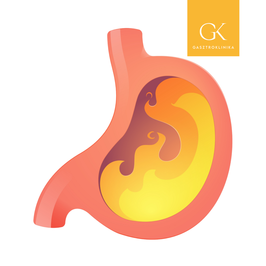 mit jelent a késleltetett gyomorürülés