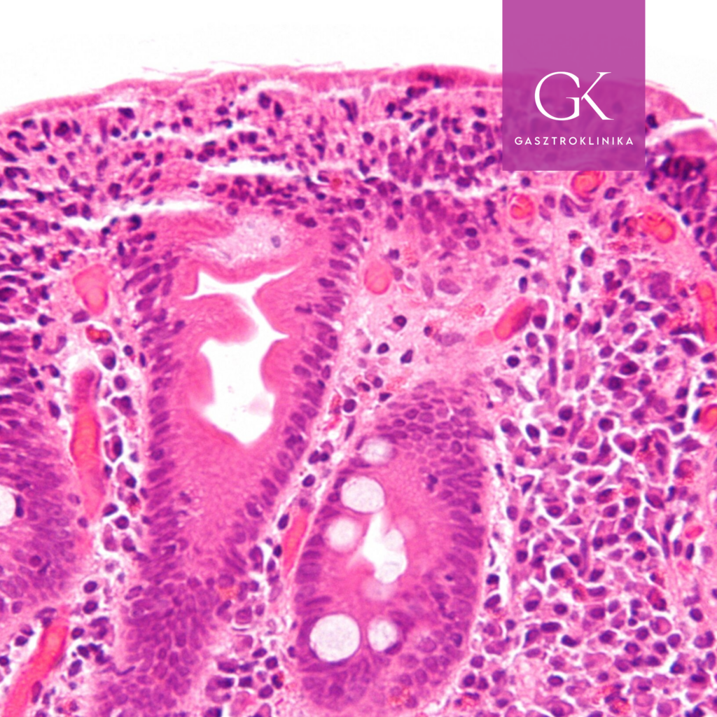 coliakia szovettan vekonybel biopszia bolykok